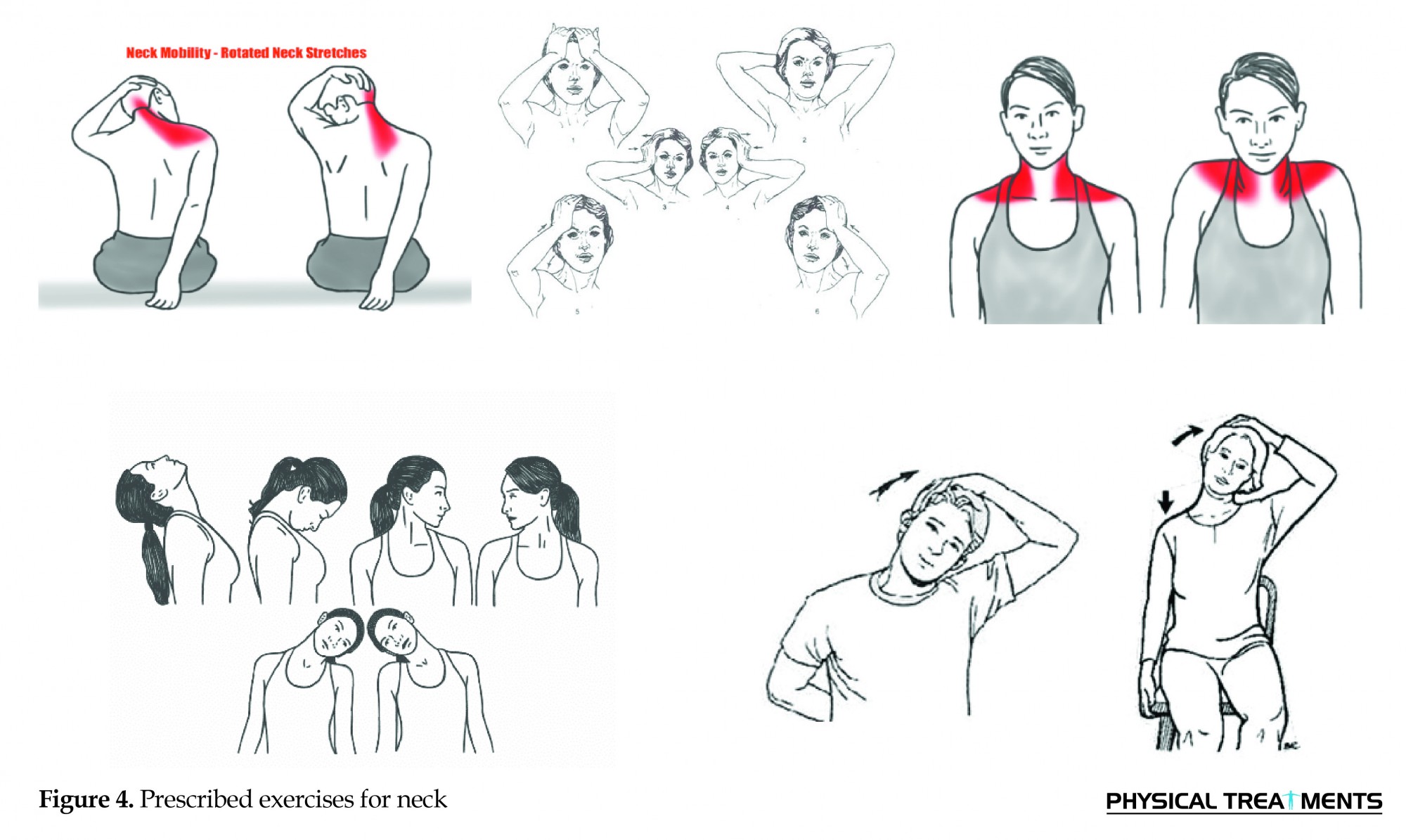 The Effect Of Combination Therapy Manual Therapy And Exercise In Patients With Non-specific Chronic Neck Pain A Randomized Clinical Trial - Physical Treatments - Specific Physical Therapy Journal